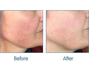 Before-and-After.-illumiFacial.-Luminette-Advance-available-at-Sparx-Winchester-Aesthetics-Clinic
