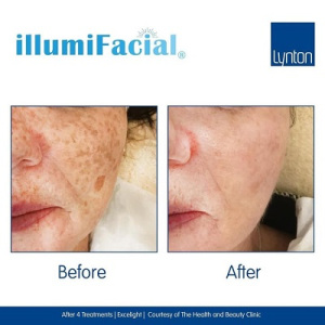 illumi-before-after-facials-at-sparx-beauty-winchester