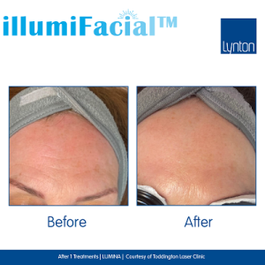 illumi-facial-before-after-at-sparx-beauty-salon-winchester